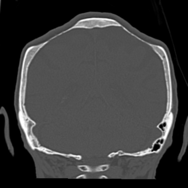 Biparietal osteodystrophy (Radiopaedia 46109-50463 Coronal bone window 76).jpg