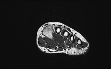 Bipartite hallux sesamoid diastasis (Radiopaedia 77133-89109 Coronal PD 12).jpg