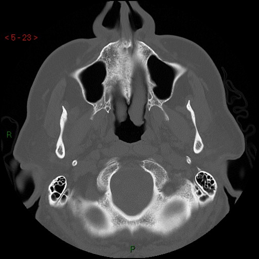 Bisphosphonate-related osteonecrosis of the jaw (Radiopaedia 54147-60329 Axial bone window 17).jpg