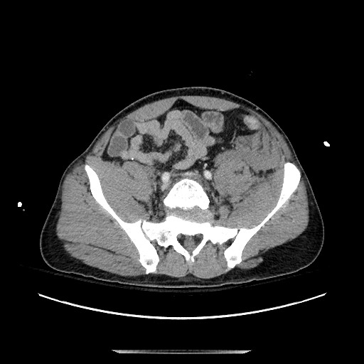 Blunt abdominal trauma with solid organ and musculoskelatal injury with active extravasation (Radiopaedia 68364-77895 A 115).jpg