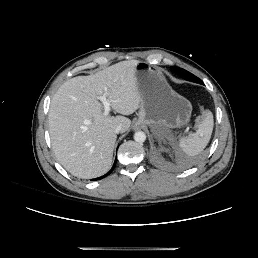 Blunt abdominal trauma with solid organ and musculoskelatal injury with active extravasation (Radiopaedia 68364-77895 A 25).jpg