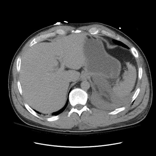 Blunt abdominal trauma with solid organ and musculoskelatal injury with active extravasation (Radiopaedia 68364-77895 Axial C+ delayed 27).jpg