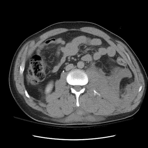 File:Blunt abdominal trauma with solid organ and musculoskelatal injury with active extravasation (Radiopaedia 68364-77895 Axial C+ delayed 69).jpg
