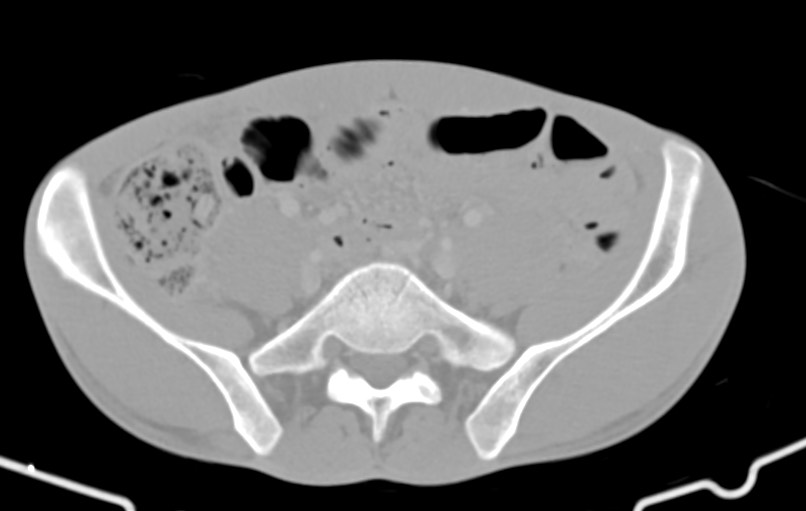 Blunt injury to the small bowel (Radiopaedia 74953-85987 Axial Wide 69).jpg