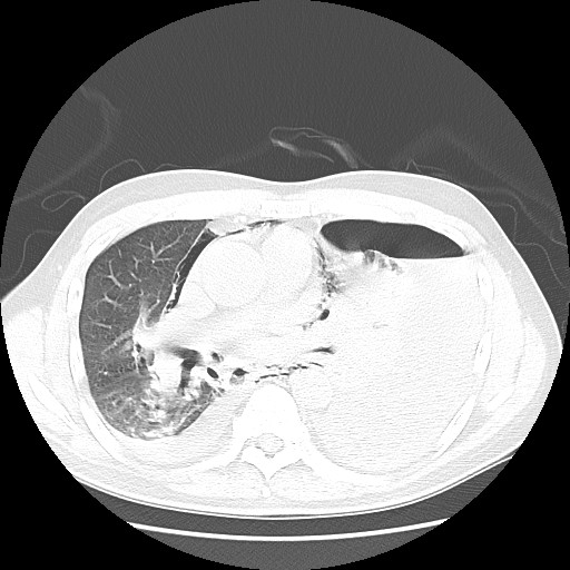 File:Boerhaave syndrome (Radiopaedia 59796-67310 Axial lung window 33).jpg