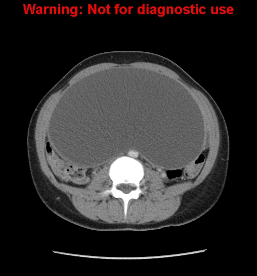 Borderline mucinous cystadenoma of ovary (Radiopaedia 25586-25767 A 34).jpg