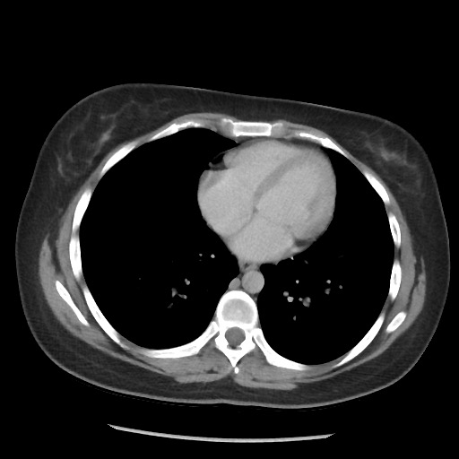 File:Borderline mucinous tumor (ovary) (Radiopaedia 78228-90808 A 58).jpg