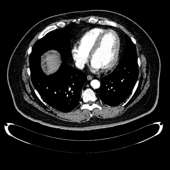 Bosniak renal cyst - type IV (Radiopaedia 24244-24518 B 1).jpg