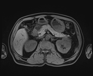 Bouveret syndrome (Radiopaedia 61017-68856 Axial T1 fat sat 36).jpg