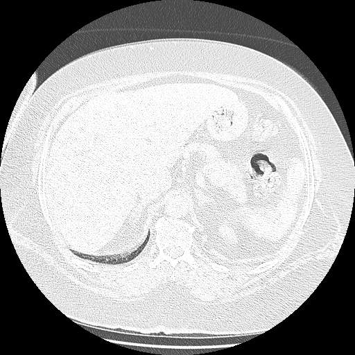 Bovine aortic arch - right internal mammary vein drains into the superior vena cava (Radiopaedia 63296-71875 Axial lung window 178).jpg