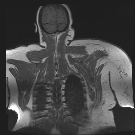 File:Brachial plexopathy (Radiopaedia 21844-21806 Coronal T1 C+ 18).jpg