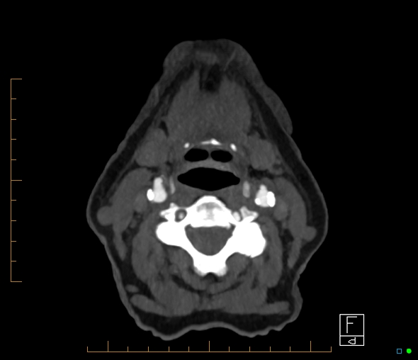 Brachiocephalic trunk stenosis (Radiopaedia 87242-103519 A 94).jpg