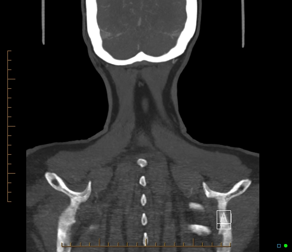 Brachiocephalic trunk stenosis (Radiopaedia 87242-103519 B 68).jpg