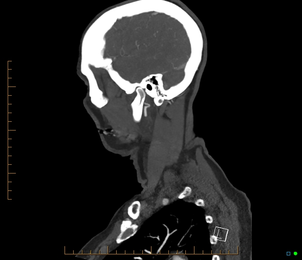 Brachiocephalic trunk stenosis (Radiopaedia 87242-103519 C 11).jpg