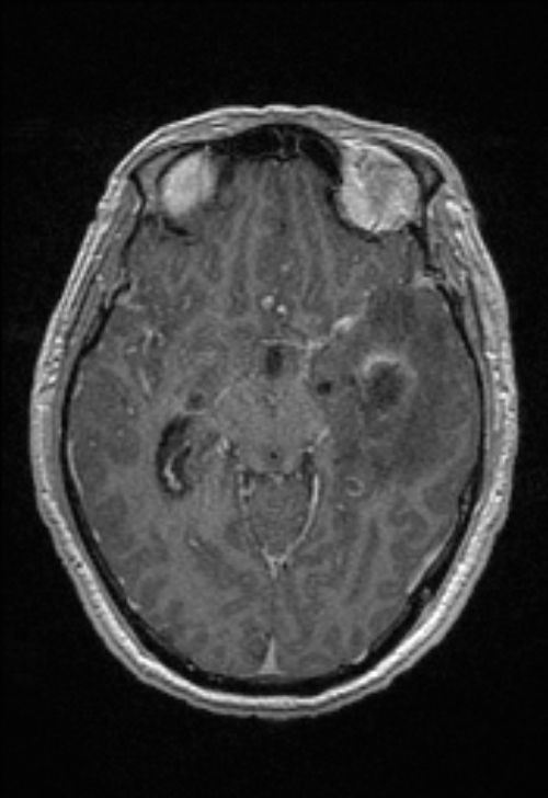 Brain abscess with ventriculitis (Radiopaedia 85703-101495 Axial T1 C+ 78).jpg