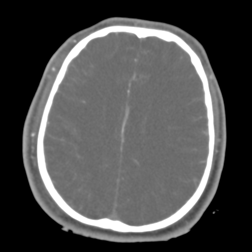 Brain contusions, internal carotid artery dissection and base of skull fracture (Radiopaedia 34089-35339 D 19).png