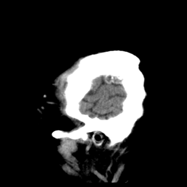 Brain cortical laminar necrosis (Radiopaedia 25822-25971 non-contrast 46).jpg