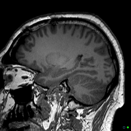 Brain death on MRI and CT angiography (Radiopaedia 42560-45689 Sagittal T1 51).jpg
