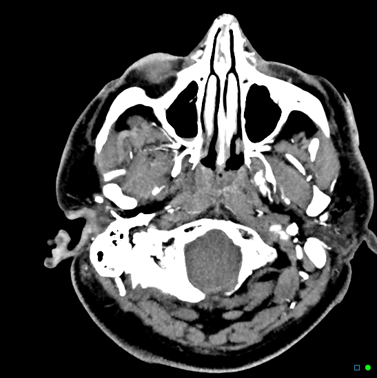 Brain death on MRI and CT angiography (Radiopaedia 42560-45841 B 47).jpg