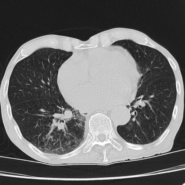 Brain metastases from lung cancer (Radiopaedia 27849-28093 Axial lung window 43).jpg