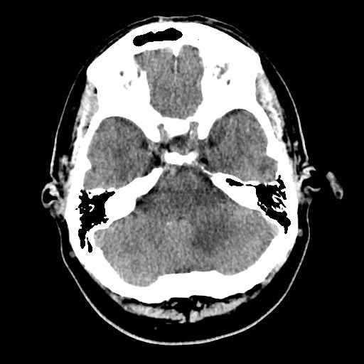 File:Brain metastases from lung cancer (Radiopaedia 83839-99027 Axial non-contrast 8).jpg