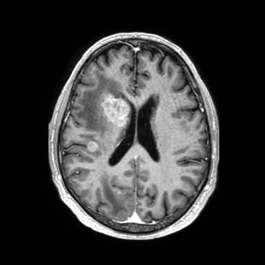 Brain metastases from lung cancer (Radiopaedia 83839-99028 Axial T1 C+ 40).jpg