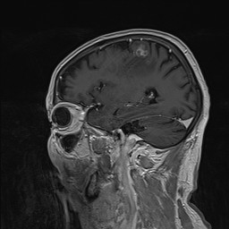 Brain metastasis (Radiopaedia 42617-45761 Sagittal T1 C+ 30).jpg