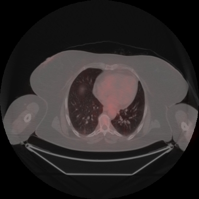 Brain metastasis (Radiopaedia 89847-106962 Axial lung window 39).jpg