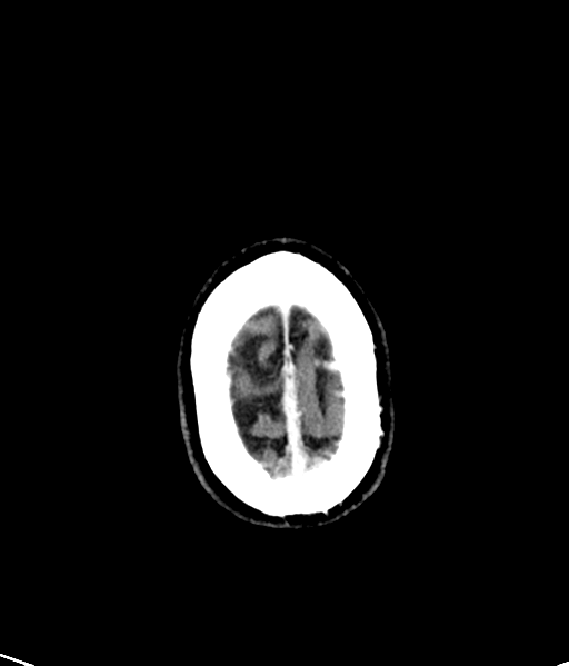 Brain metastasis (large cystic mass) (Radiopaedia 47497-52106 Axial C+ 53).png