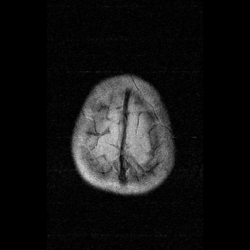 File:Brainstem ganglioglioma (Radiopaedia 10763-11224 Axial FLAIR 2).jpg