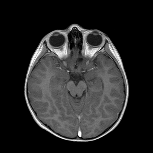 File:Brainstem ganglioglioma (Radiopaedia 10763-11224 Axial T1 C+ 5).jpg