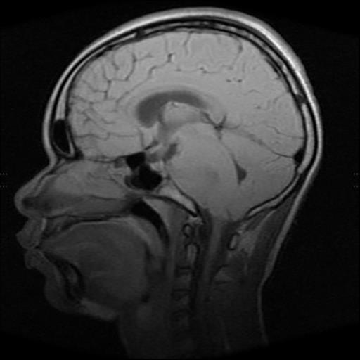 File:Brainstem glioma (Radiopaedia 30923-31624 Sagittal T1 10).jpg