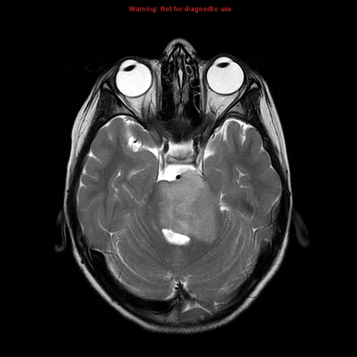 File:Brainstem glioma (Radiopaedia 9444-10124 Axial T2 7).jpg