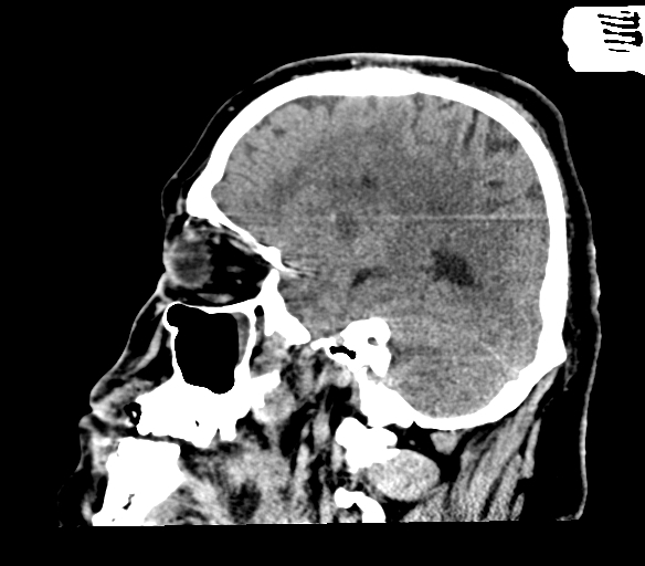 File:Brainstem hemorrhage (Radiopaedia 81294-94976 C 18).jpg
