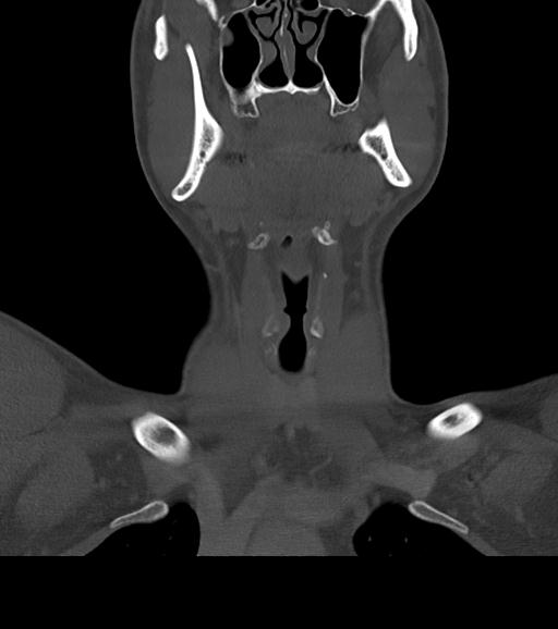 Branchial cleft cyst (Radiopaedia 31167-31875 Coronal bone window 25).jpg