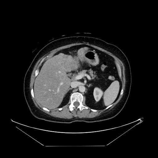 File:Breast cancer pseudocirrhosis with lobar invovlement (Radiopaedia 81080-94670 A 56).jpg