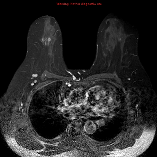 File:Breast carcinoma (multicentric multifocal in mammary Paget disease) (Radiopaedia 50966-56512 Axial T1 C+ fat sat 11).jpg