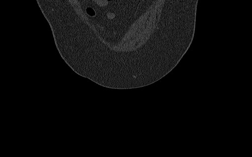 Breast carcinoma with pathological hip fracture (Radiopaedia 60314-67993 Coronal bone window 26).jpg