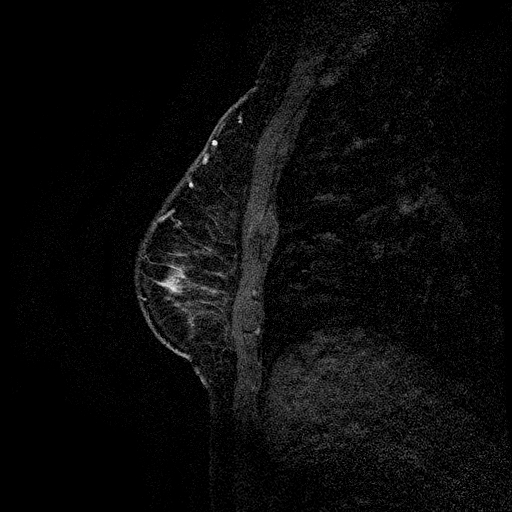 File:Breast lipoma and cancer (Radiopaedia 15118-14995 D 6).jpg