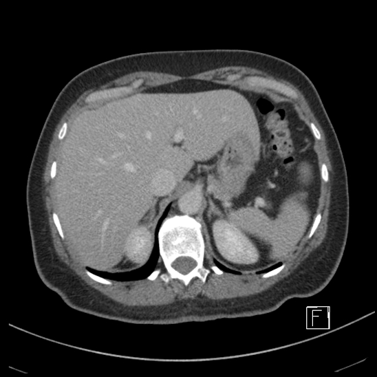 Breast metastases from renal cell cancer (Radiopaedia 79220-92225 C 19).jpg