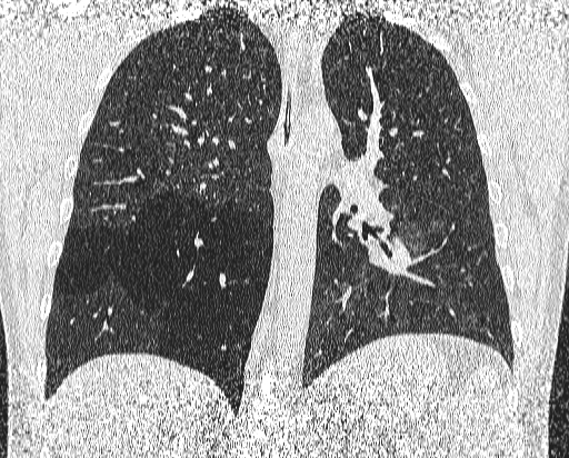 Bronchial atresia (Radiopaedia 58271-65417 Coronal lung window 36).jpg