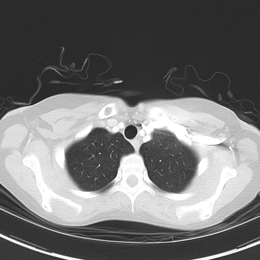 File:Bronchial atresia (Radiopaedia 73677-84470 Axial lung window 11).jpg