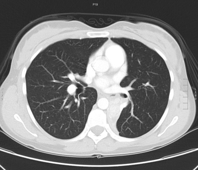 File:Bronchial carcinoid tumor (Radiopaedia 15042-42507 Axial lung window 4).jpg