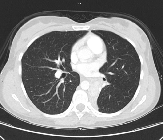 File:Bronchial carcinoid tumor (Radiopaedia 15042-42507 Axial lung window 5).jpg