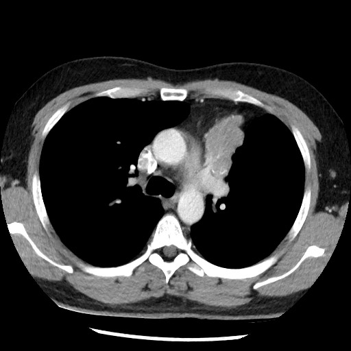 Bronchial carcinoid tumor (Radiopaedia 67377-76764 A 25).jpg