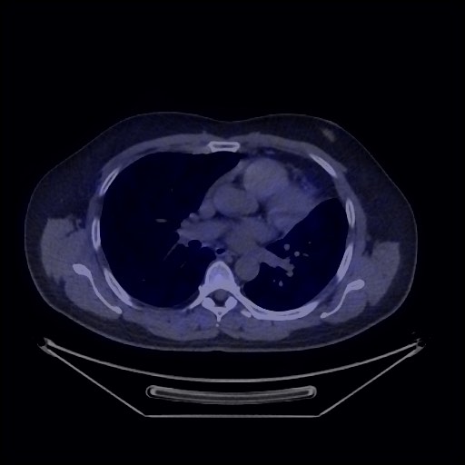 File:Bronchial carcinoid tumor (Radiopaedia 67377-76765 68Ga-DOTATATE PET-CT 32).jpg