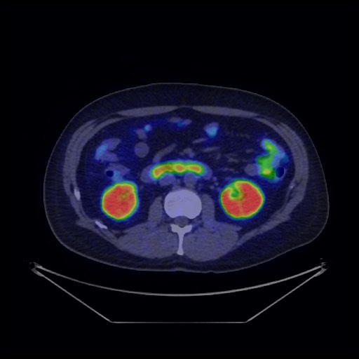 Bronchial carcinoid tumor (Radiopaedia 67377-76765 68Ga-DOTATATE PET-CT 51).jpg