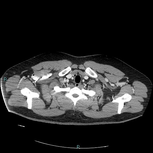 File:Bronchial carcinoid tumor (Radiopaedia 78272-90875 A 15).jpg