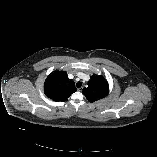 File:Bronchial carcinoid tumor (Radiopaedia 78272-90875 A 24).jpg