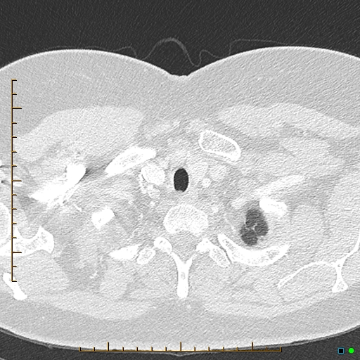 Bronchial diverticula (Radiopaedia 79512-92676 Axial lung window 1).jpg
